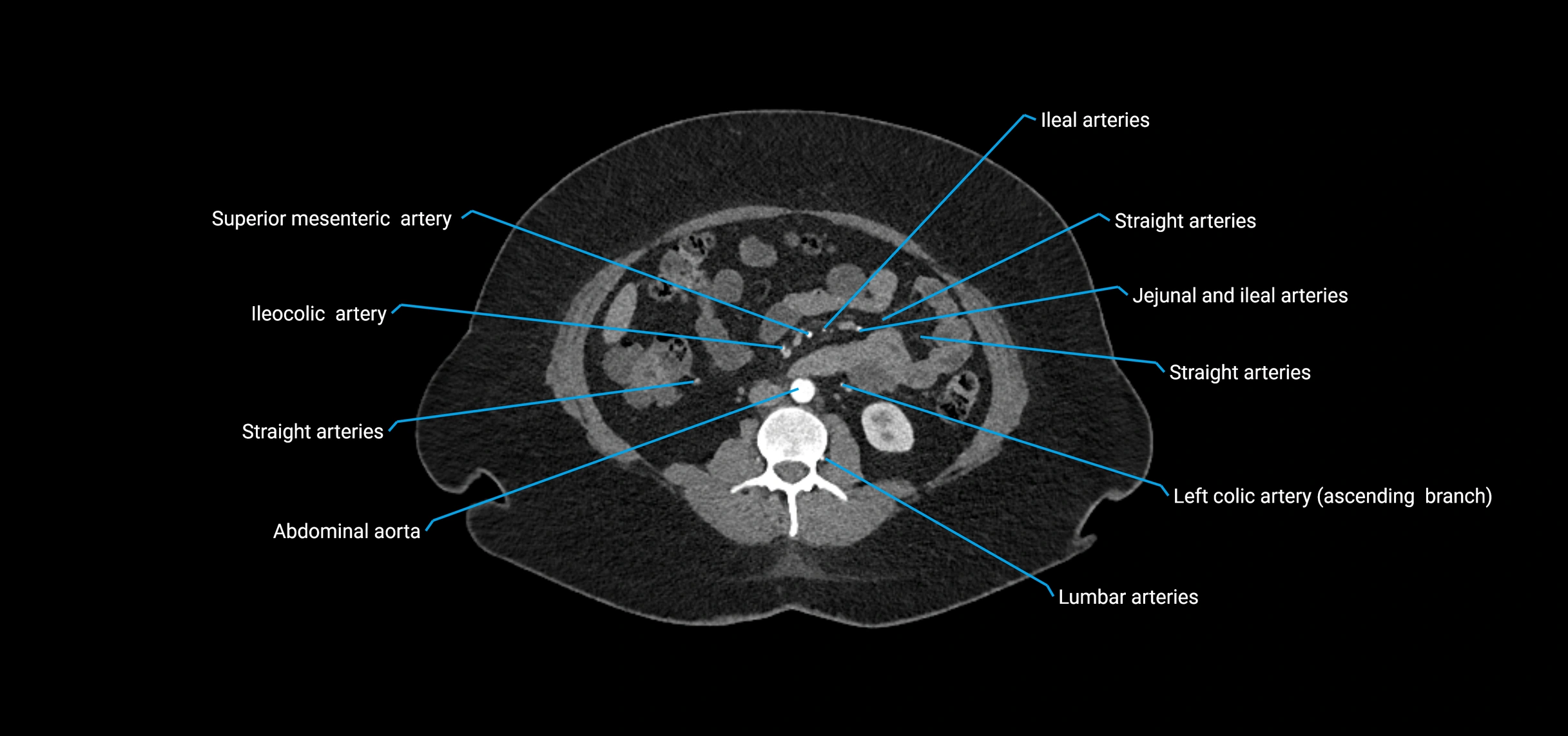 CTA abdomen axial cross sectional anatomy labelled image_99 (2).webp